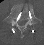 PLIF misplaced screw axial CT